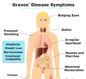 primary signs of Graves disease